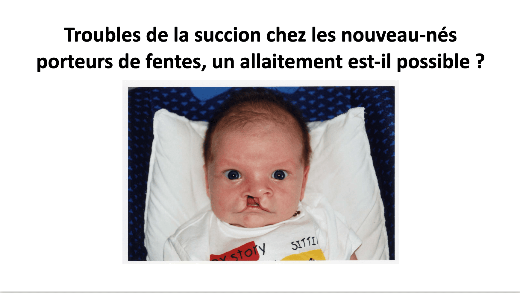 Les troubles de la succion chez les nouveau-nés porteurs de fentes, un allaitement est-il possible ?